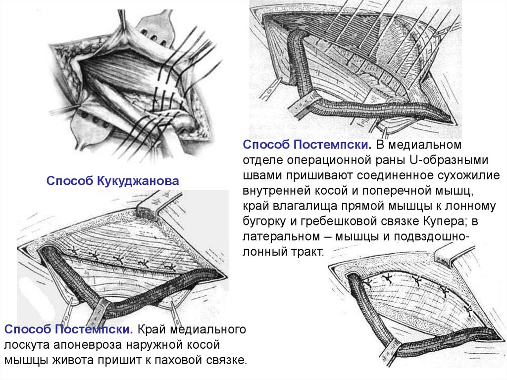 Где передняя брюшная стенка