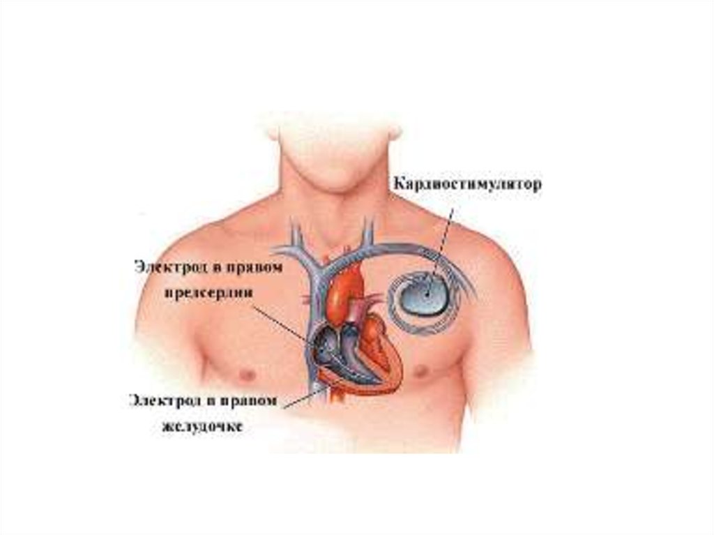 Почему в инструкции людям с кардиостимуляторами запрещается. Имплантация электрокардиостимулятора. Постоянный электрокардиостимулятор. Установленный кардиостимулятор.