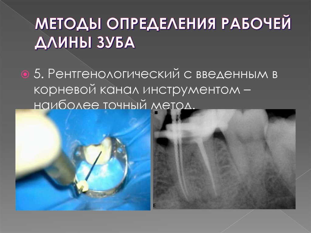 Ирригация корневых каналов презентация