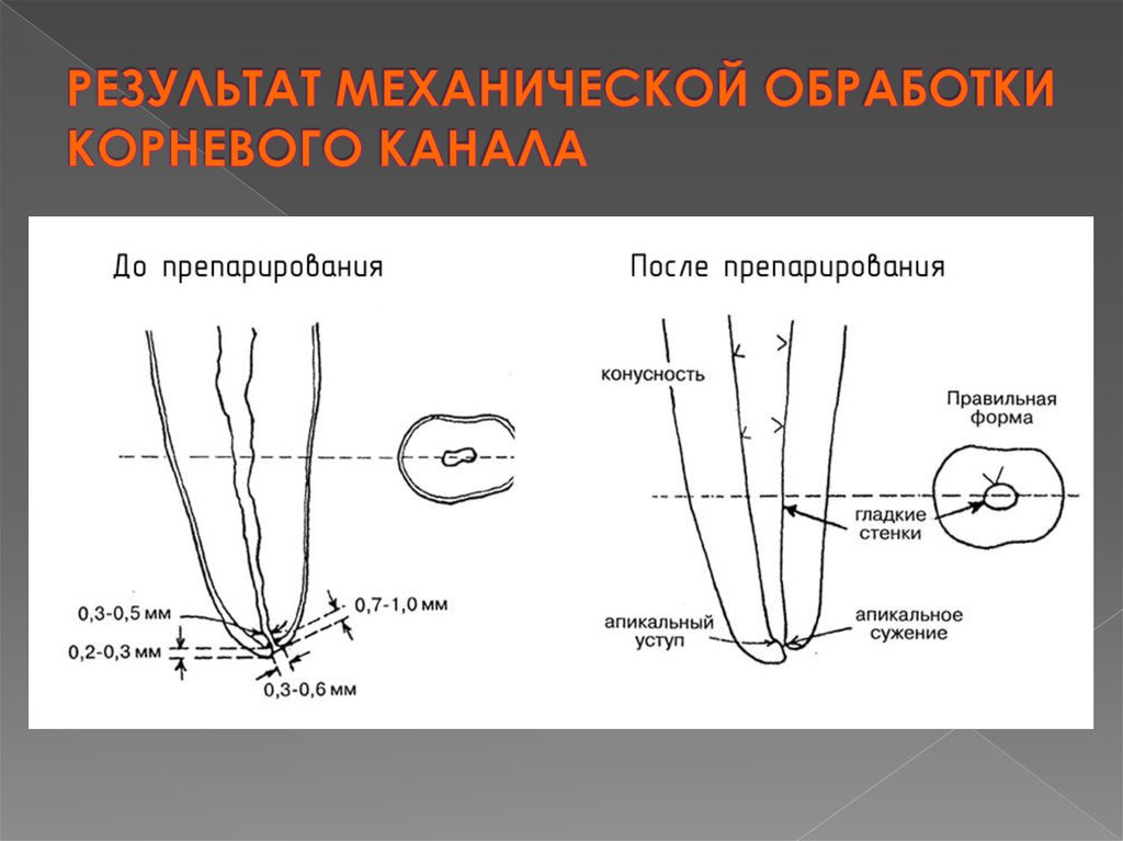 Машинная обработка корневых каналов