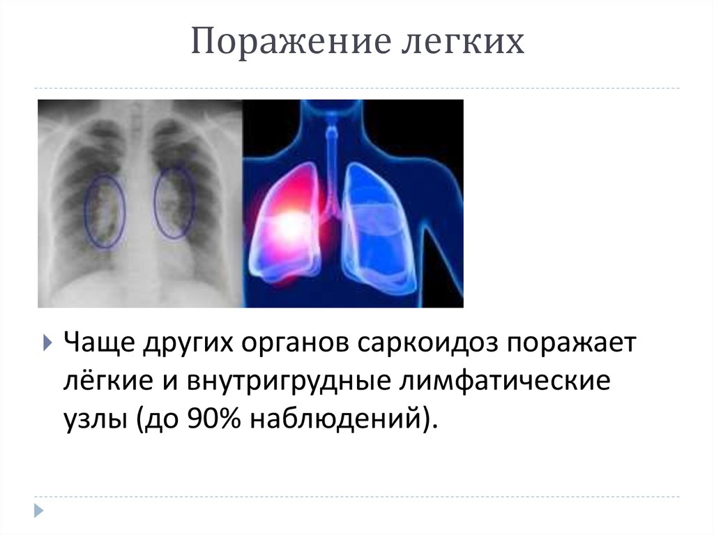 10 поражение легких