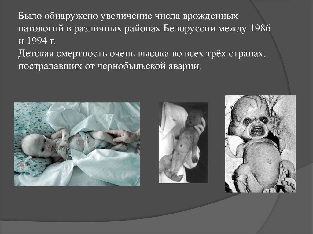 Было обнаружено увеличение числа врождённых патологий в различных районах Белоруссии между 1986 и 1994 г. Детская смертность