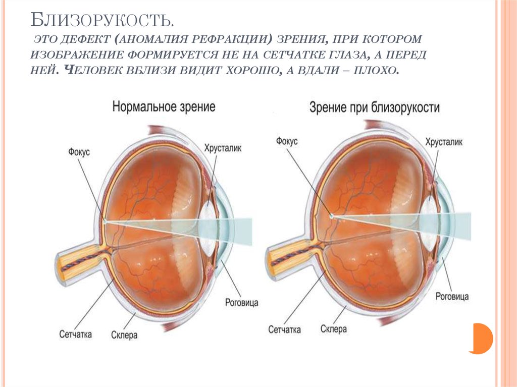 Слабая миопия глаза что. Близорукость глаз. Нормальное зрение и зрение при близорукости. Близорукость сетчатка. Строение глаза при миопии.