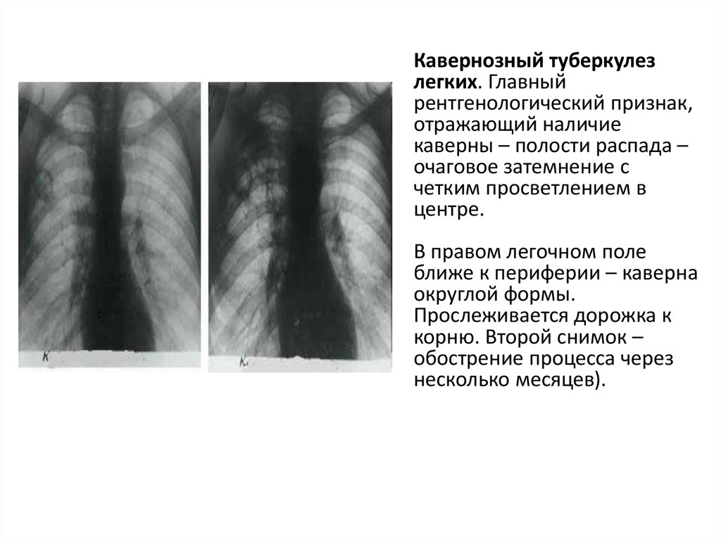 Описание рентгенограммы легких