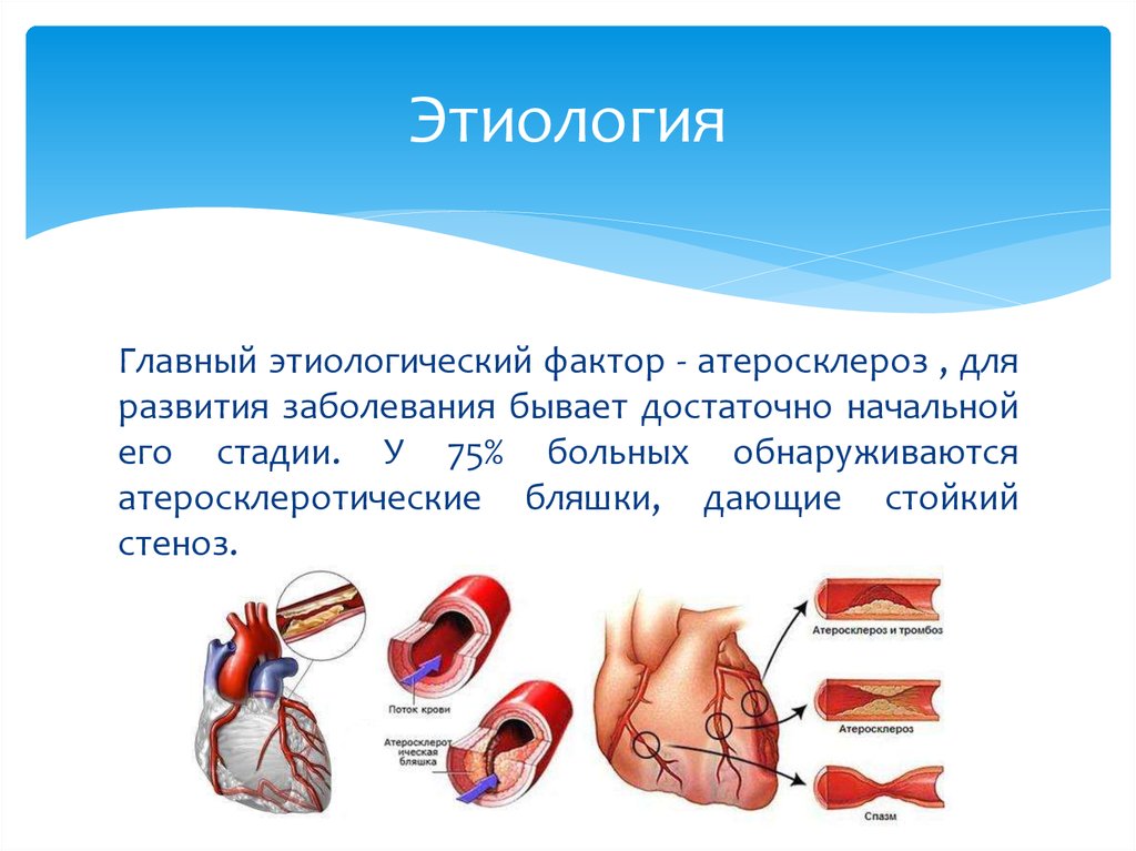 Стенокардия презентация по фармакологии