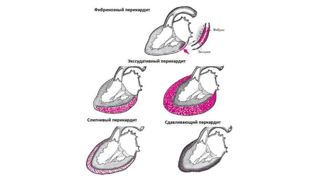 Перикардит. Патогенез перикардита схема. Сухой и экссудативный перикардит.
