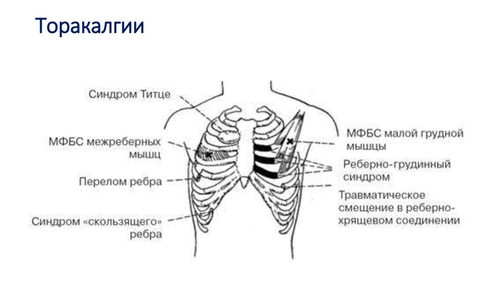 Припухлость ребра слева. Болит посередине грудины. Что справа под грудной клеткой.