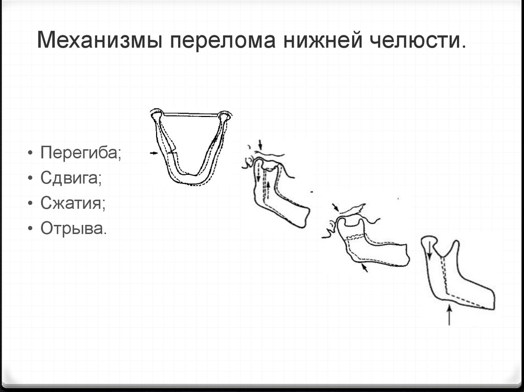 Перелом нижней челюсти карта вызова