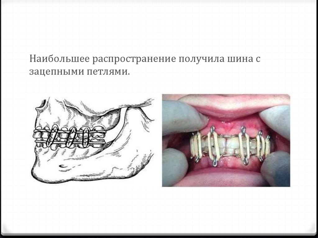 Одностороннее шинирование челюсти фото