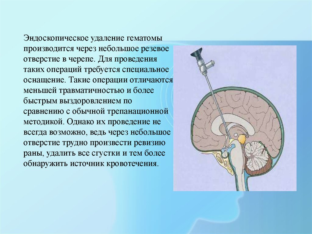 Удаление гематомы мозга