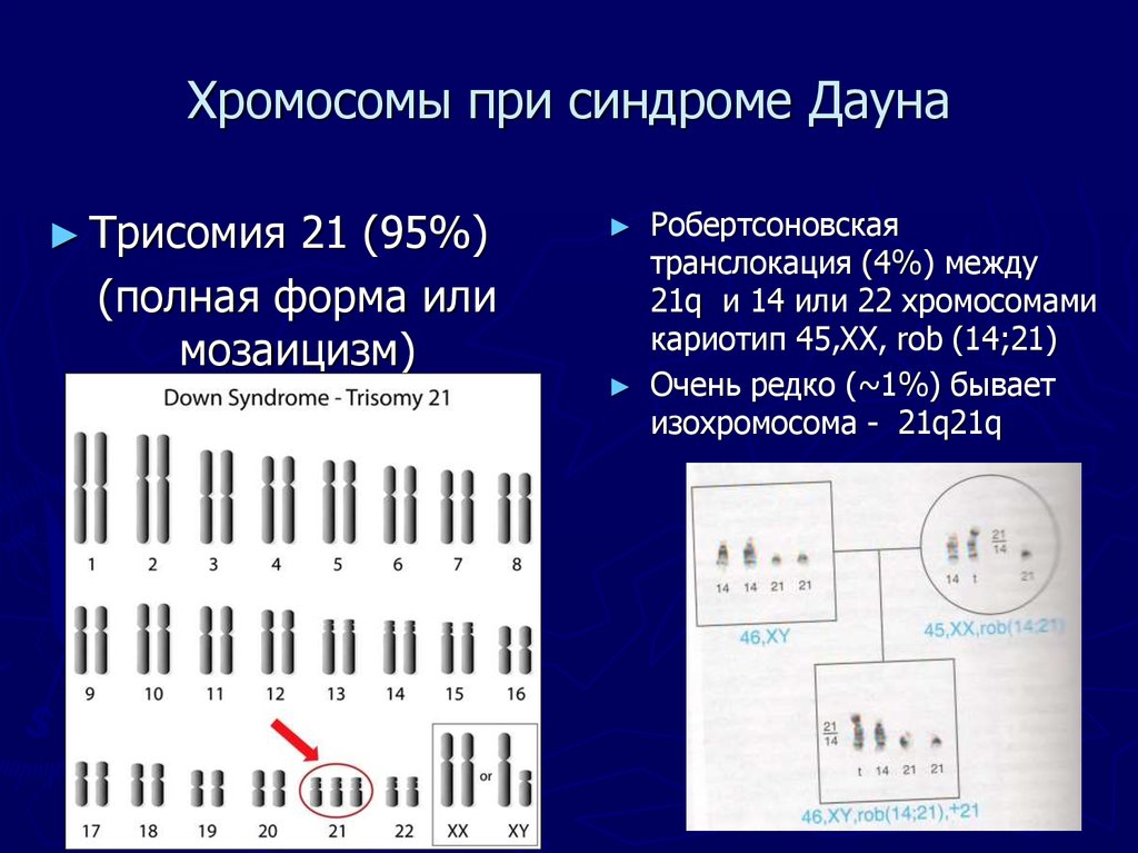 4 хромосома заболевание. Робертсоновская транслокация 21 хромосомы кариотип. Синдром Патау трисомия по 13 хромосоме. Синдром Патау (трисомия в 13-Ой хромосоме);. Хромосомные болезни синдром Патау.