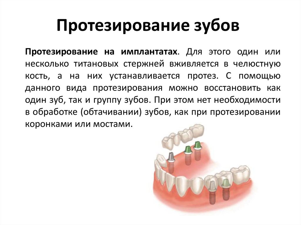 Возмещение за зубы. Методы протезирования зубов. Протезирование зубов схема.