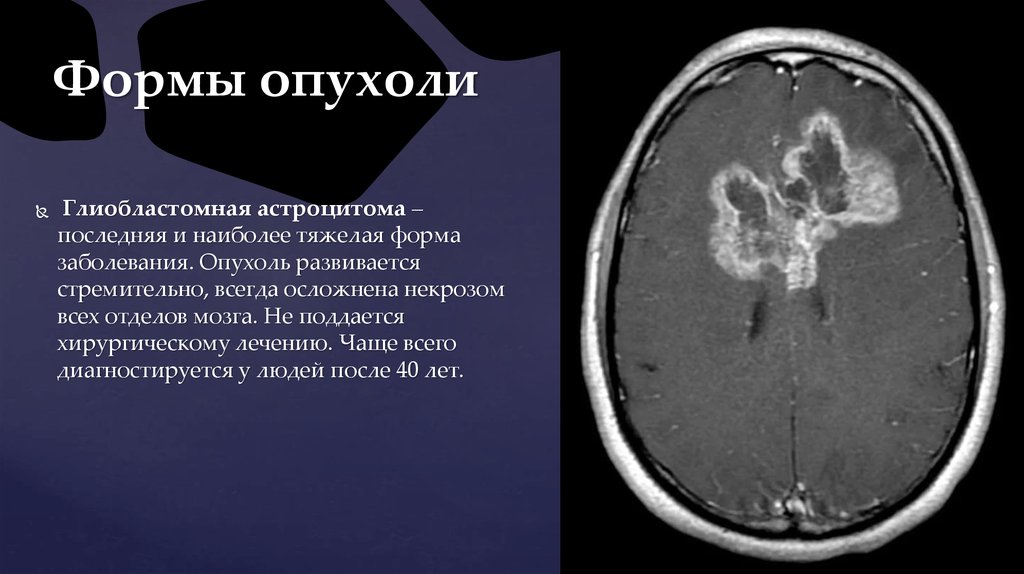 Глиома опухоль. Глиома головного мозга гистология.
