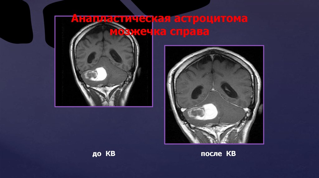 Глиома у детей. Анапластическая астроцитома ствола головного мозга. Астроцитома головного мозга в стволе. Глиома (астроцитома, эпендимома).