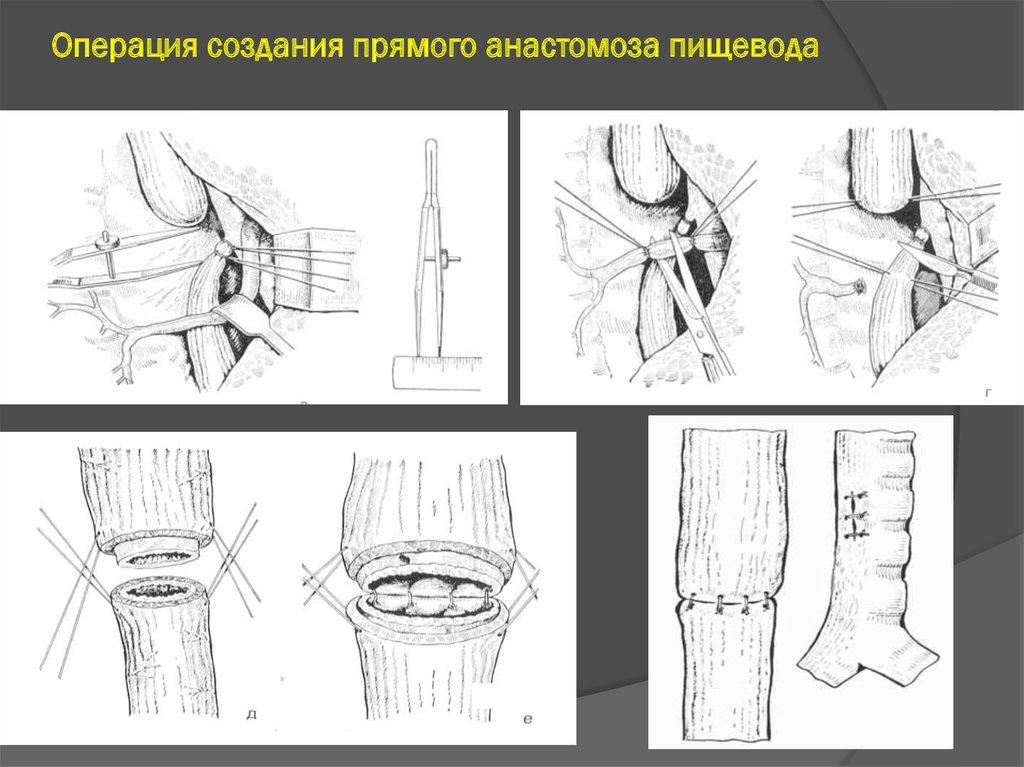 Атрезия прямой кишки операция. Атрезия пищевода хирургия. Торакотомия при атрезии пищевода. Операции при атрезии пищевода прямой анастомоз. Торакотомия анастомоз пищевода.