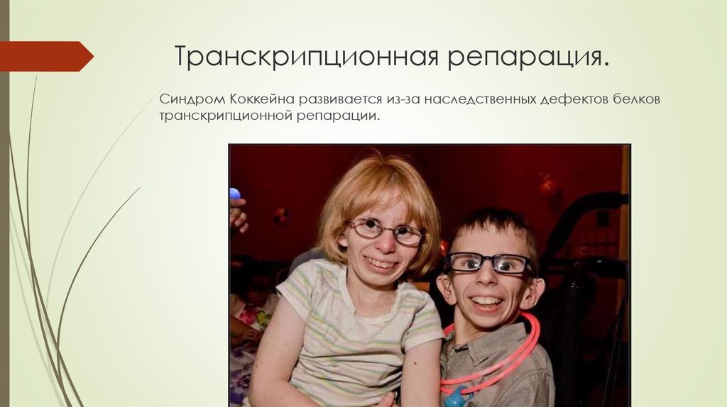 Синдром коккейна. Транскрипционная репарация. Синдром Вебера-Коккейна.