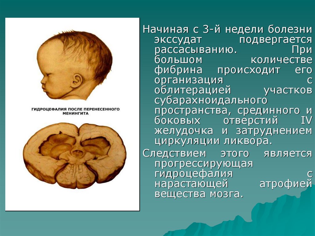 Гидроцефалия головного мозга что это. Гидроцефалия при менингите. Гидроцефалия после менингита. Гидроцефалия мозга бактериальные инфекции. Генерализованная гипотрофическая гидроцефалия..