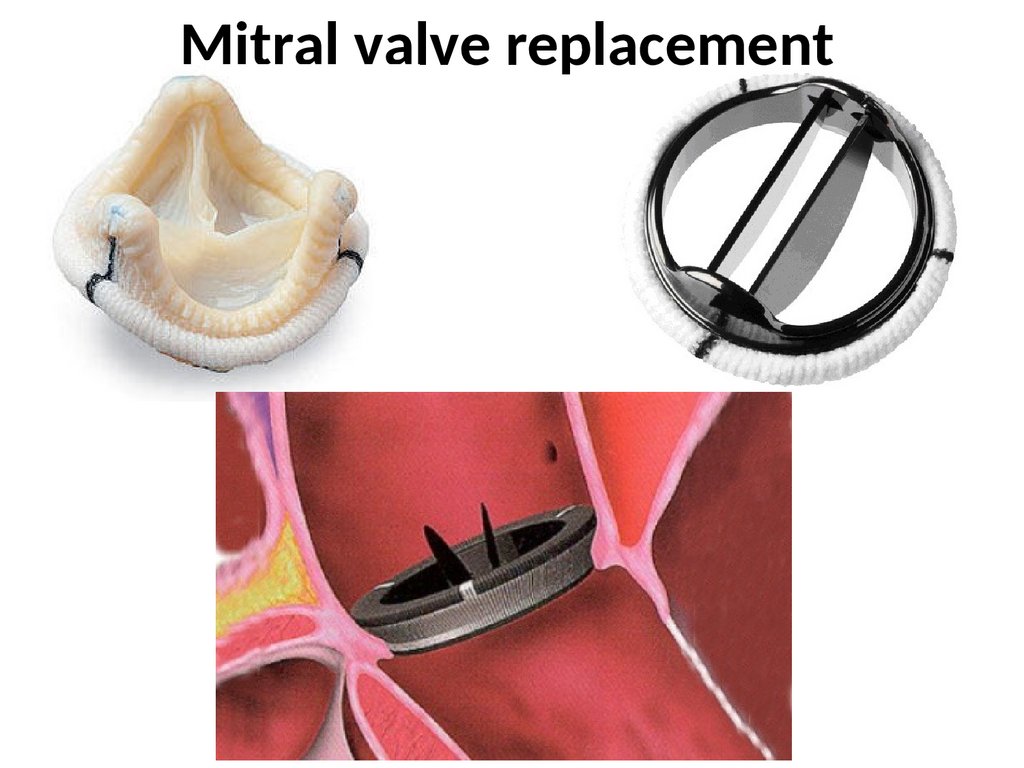 Valvular Heart Disease Mitral Valve презентация онлайн