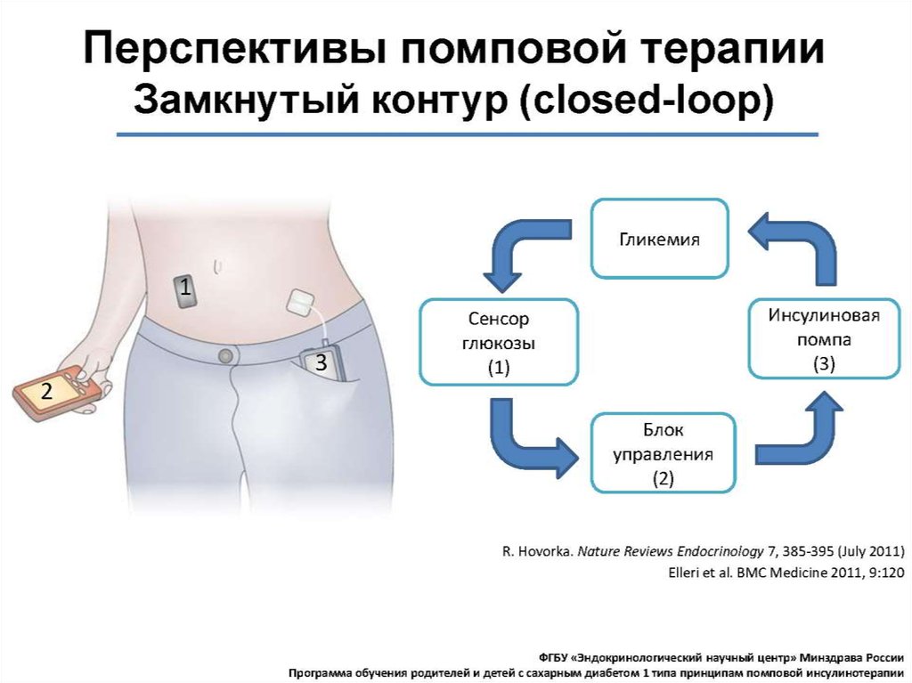 Помповая инсулинотерапия