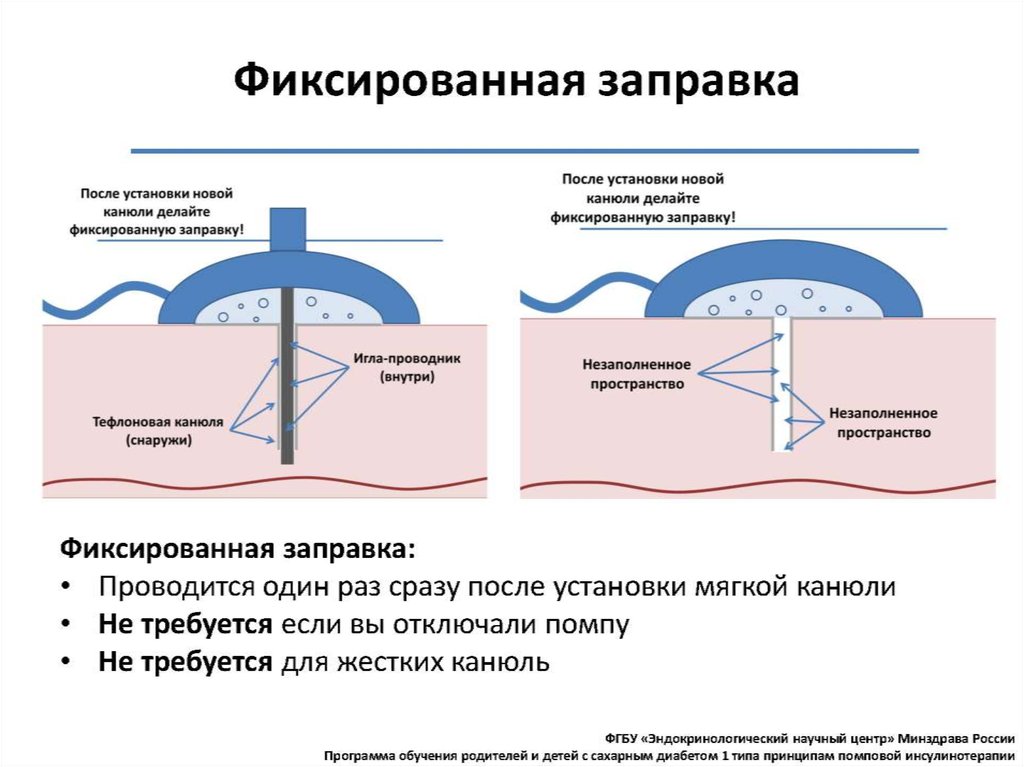 Помповая инсулинотерапия презентация