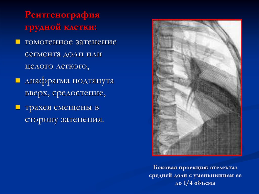 Боковая проекция. Ателектаз средней доли рентген. Ателектаз в боковой проекции. Ателектаз верхней доли справа боковая проекция. Ателектаз средней доли боковая проекция.