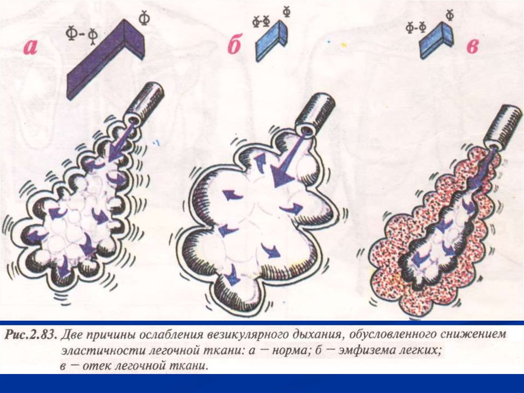 Везикулярное дыхание схема
