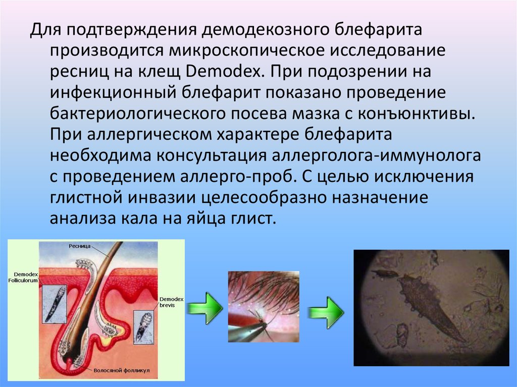 Демодекозный блефарит. Исследование ресниц на демодекс. Микроскопическое обследование демодекс.