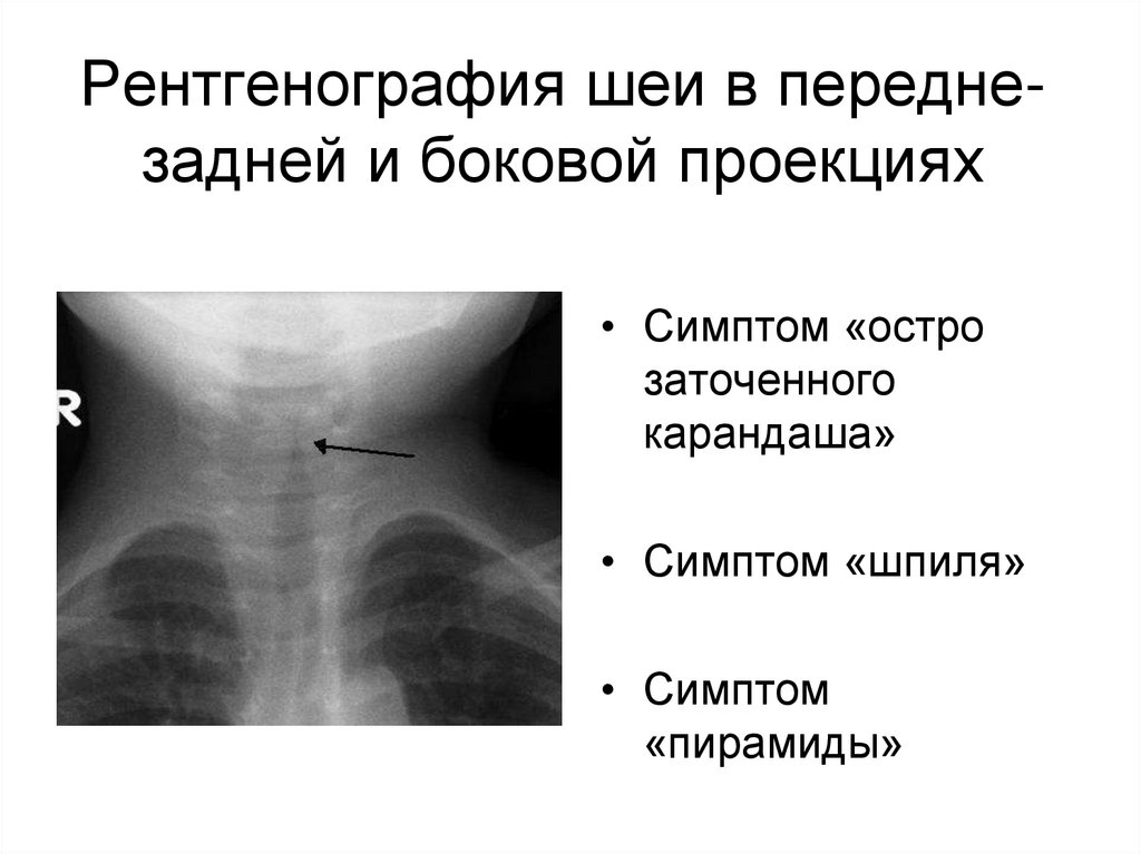 Рентгенография шеи в передне-задней и боковой проекциях