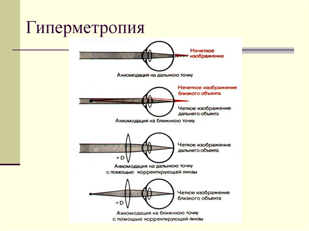 Гиперметропия слабой степени что это