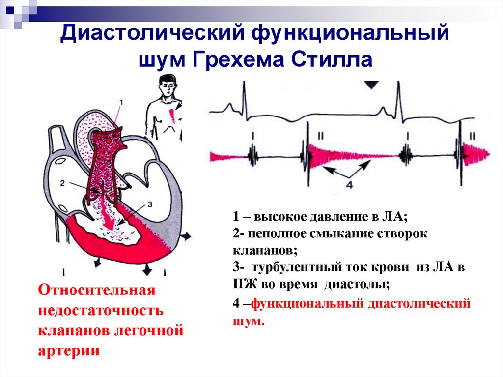 Шум остина флинта выслушивается в точке обозначенной на рисунке цифрой