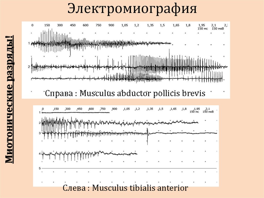 Эмг. ЭМГ при миотонии. 