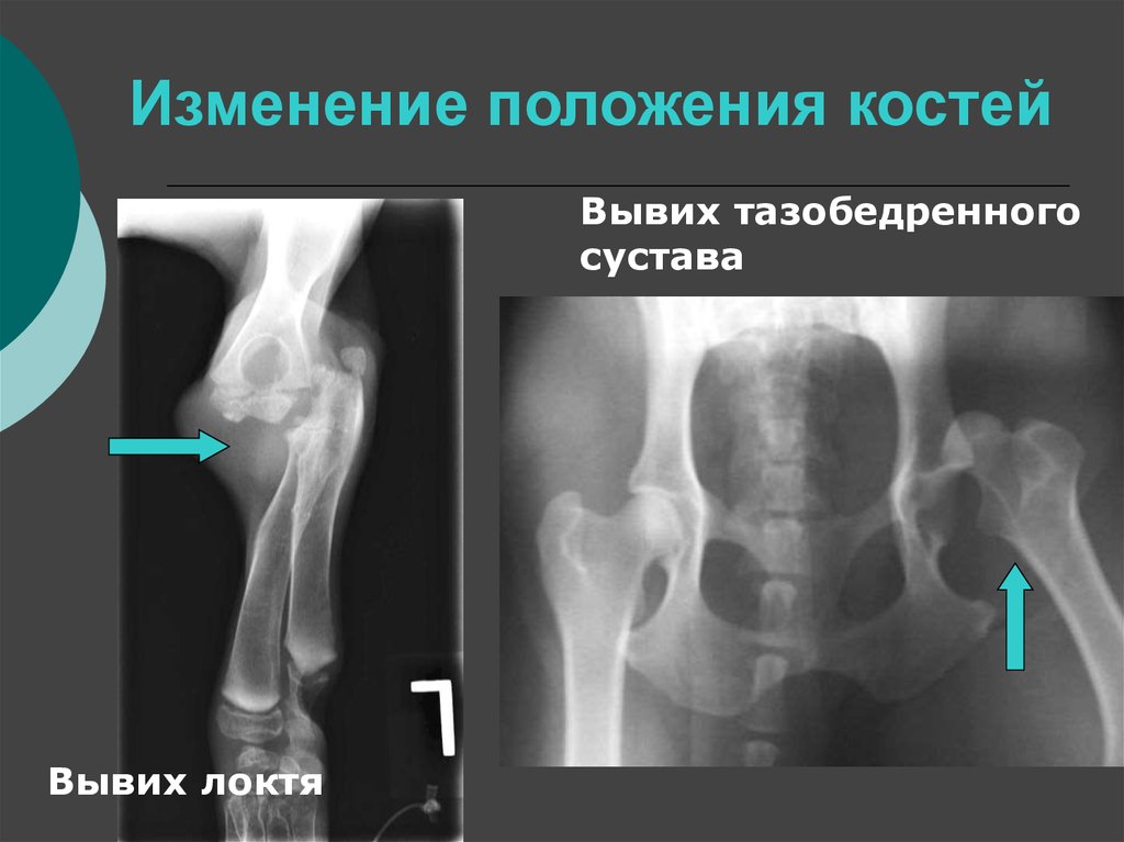 Положение костей. Изменение положения костей. Вывих тазобедренного сустава презентация. Вывих тазобедренного сустава симптомы. Как выглядит смещение кости тазобедренного сустава.