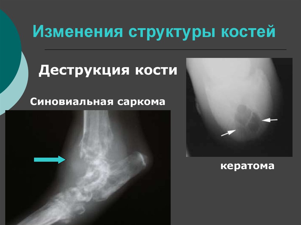 Структурные изменения костей. Изменение структуры кости. Изменения структуры костей рентген. Изменение костной структуры. Симптомы изменения структуры кости.