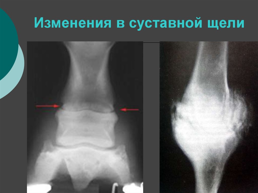 Суставная щель голеностопного сустава. Остеосклероз кости рентген. Деформирующий артроз голеностопного сустава рентген.