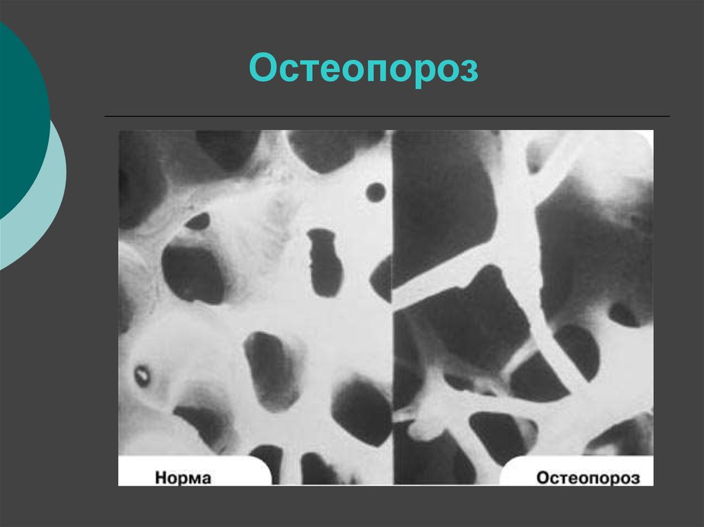 Остеопороз у детей презентация