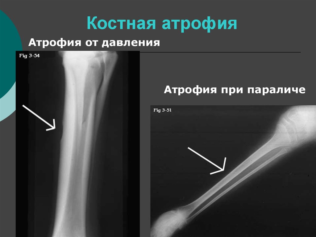 Деструкция костной ткани. Костная атрофия рентген. Концентрическая атрофия кости рентген. Атрофия кости на рентгенограмме.