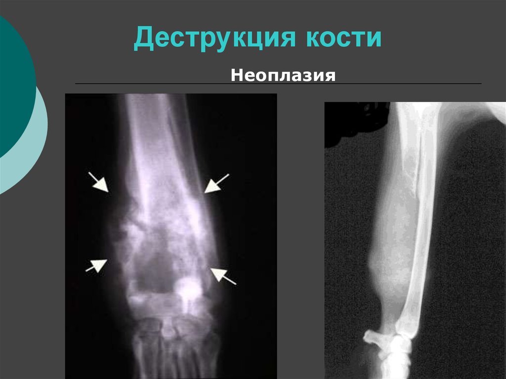 Деструкция костной ткани. Очаг деструкции костной ткани рентген. Очаг деструкции костной ткани большеберцовой кости. Деструкция кости на рентгене. Деструкция на рентгене костей.