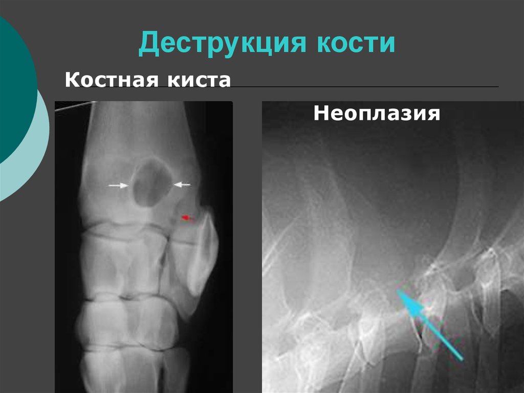 Деструкция костной ткани. Деструкция кости на рентгене. Деструкция костной ткани рентген. Деструкция кисти ренгтен.