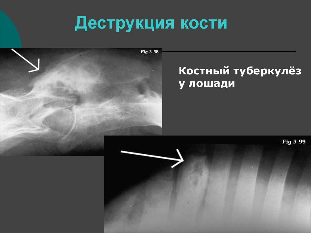 Деструкция костной ткани. Деструкция кости на рентгене. Очаг деструкции костной ткани.