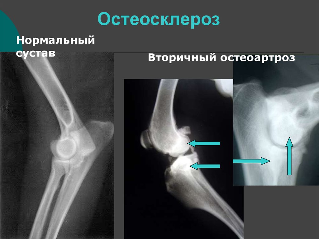 Субхондральный склероз суставных поверхностей коленного сустава. Остеопороз и остеосклероз. Остеосклероз рентген. Остеосклероз большеберцовой кости на рентгенограмме. Субхондральный остеосклероз рентген.