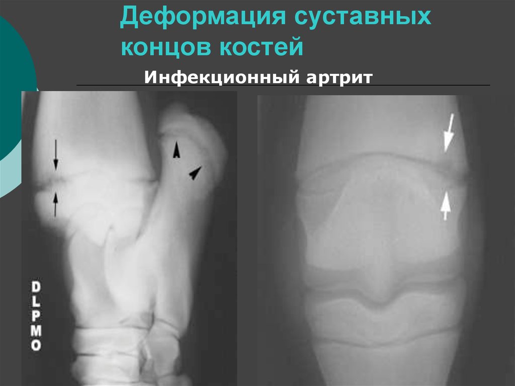 Полное расхождение суставных костей относительно друг. Костно суставные деформации. Рубцовая деформация сустава.