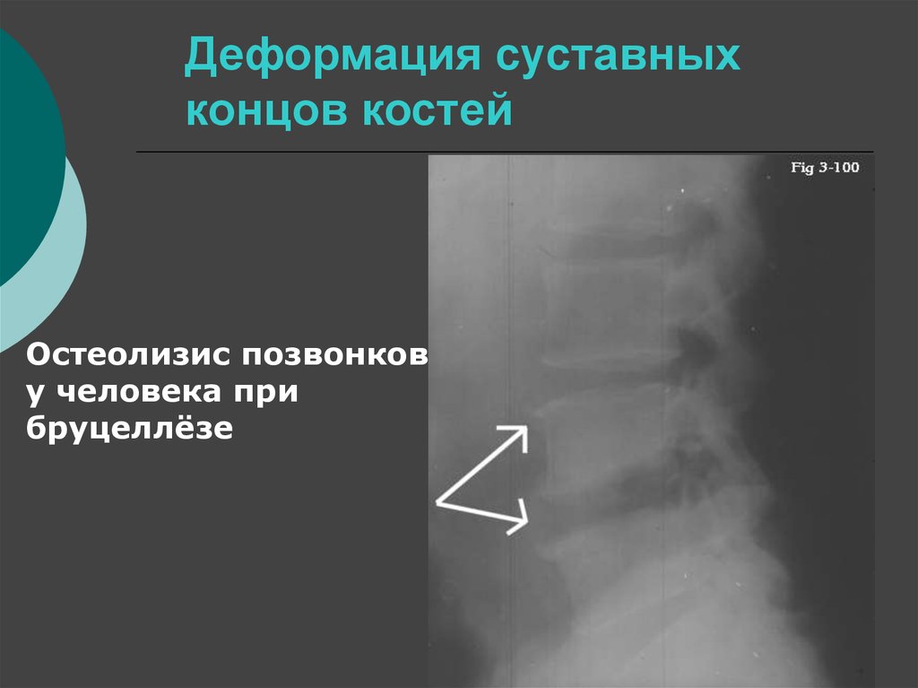 Полное расхождение суставных концов костей. Угловая деформация. Угловая деформация кости. Суставные концы костей.