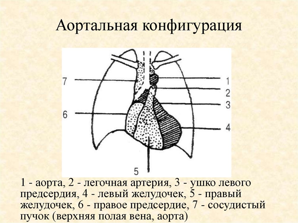 Аортальная конфигурация сердца схема