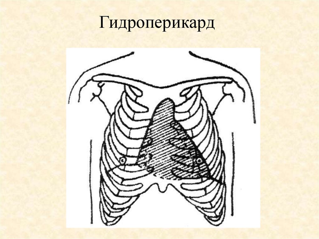 Гидроперикард. Симптомы гидроперикарда. Синдром гидроперикарда.