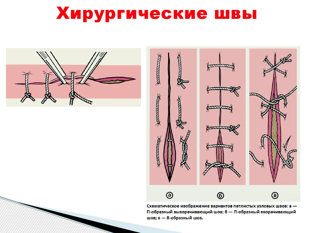 Техника наложения хирургических швов. Наложение хирургических швов. Непрерывный шов в хирургии. Название хирургических швов.