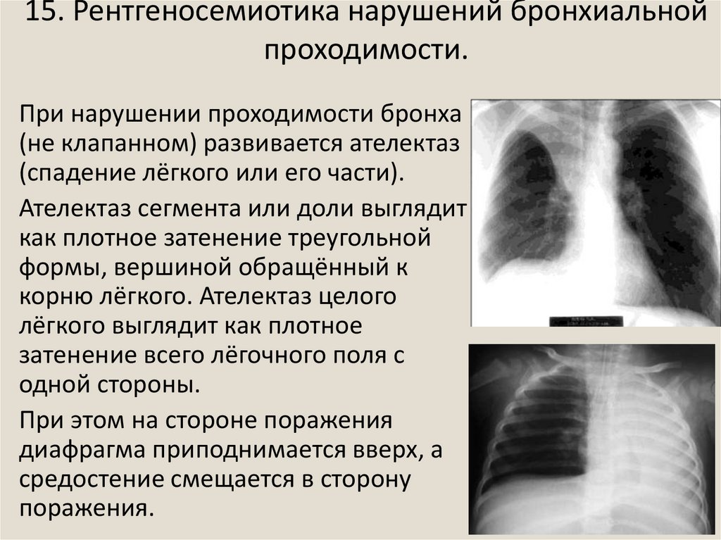 Обструктивное нарушение бронхиальной проходимости