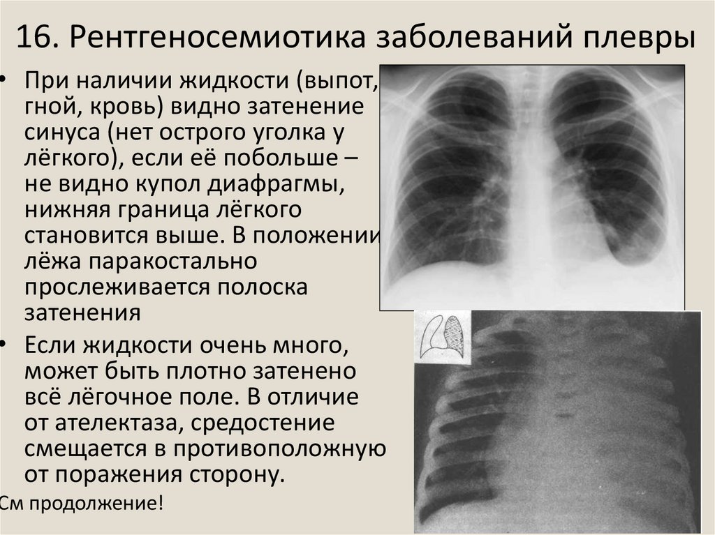 Справа было видно. Рентгеносемиотика заболеваний плевры. Рентгеносемиотика заболеваний легких. Образование плевры рентген. Лучевая диагностика.