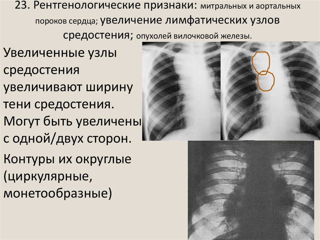 Лучевая диагностика средостения презентация