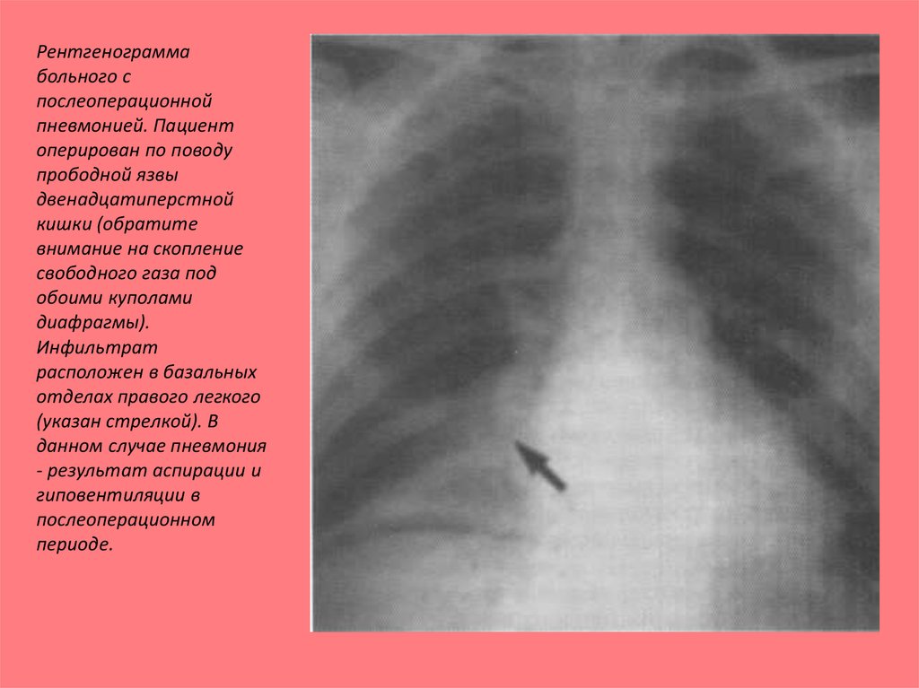 Свободный газ. Перфоративная язва купол диафрагмы. Свободный ГАЗ В брюшной полости при прободной язве желудка. Симптом серпа при перфорации язвы. Послеоперационная пневмония рентгенограмма.