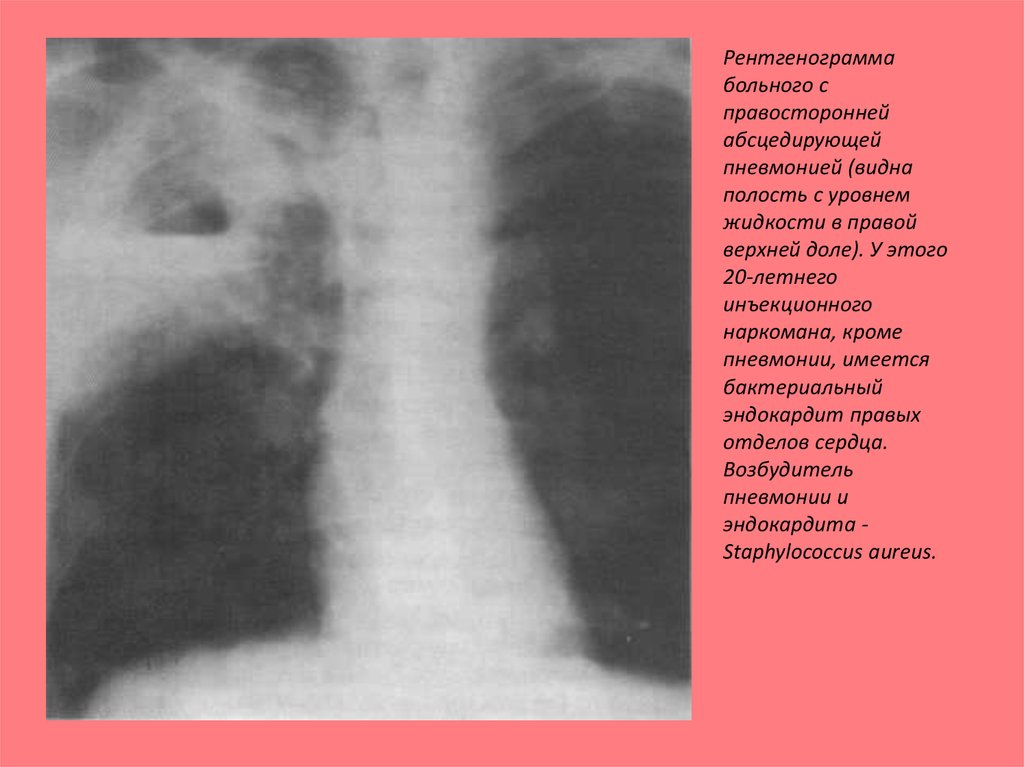 Видное пневмония. Абсцедирующая пневмония на рентгенограмме. Абсцедирующая пневмония на рентгенограмме характеризуется. Абсцедирующая пневмония презентация. Абсцедирующая пневмония верхней доли правого легкого.